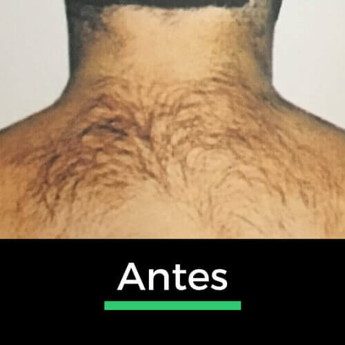 Comparação de costas masculinas antes da depilação a laser, mostrando a remoção eficaz dos pelos para uma pele lisa.