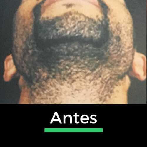 Comparação da área do pescoço antes da depilação a laser, evidenciando a definição e redução dos pelos na região da barba.