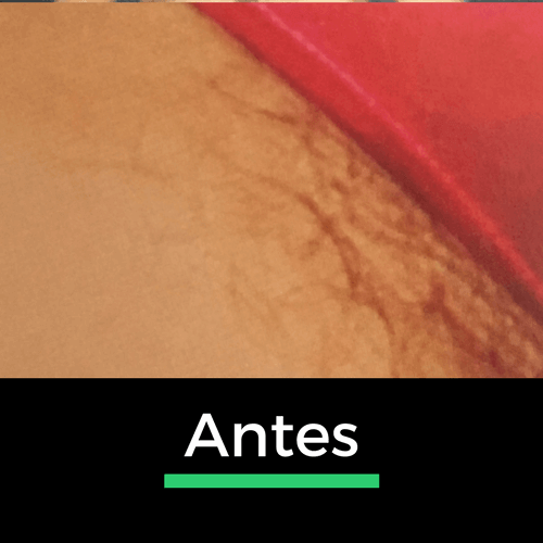 Comparação de uma virilha antes da depilação a laser, destacando a pele mais lisa e sem pelos após o tratamento.