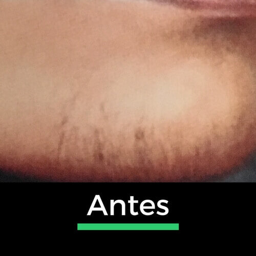 Comparação do queixo antes da depilação a laser, mostrando a eliminação dos pelos indesejados para uma pele mais uniforme.