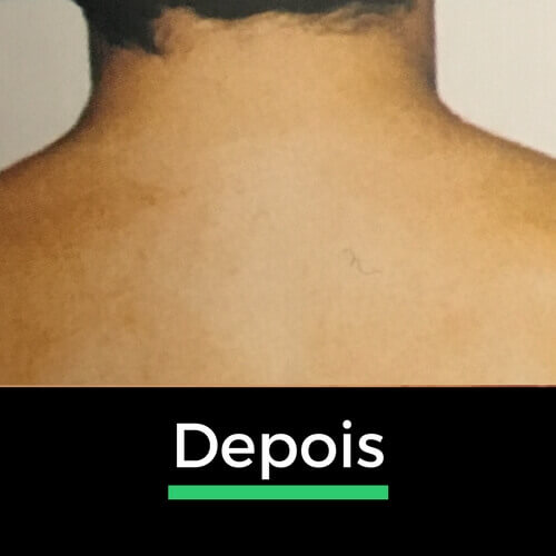 Comparação de costas masculinas depois da depilação a laser, mostrando a remoção eficaz dos pelos para uma pele lisa.