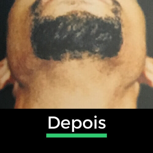 Comparação da área do pescoço depois da depilação a laser, evidenciando a definição e redução dos pelos na região da barba.