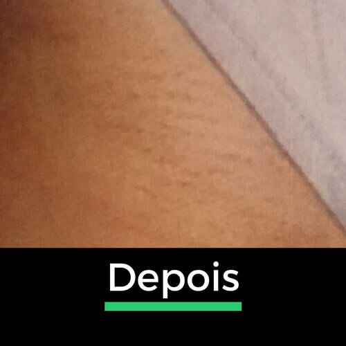 Comparação de uma virilha depois da depilação a laser, destacando a pele mais lisa e sem pelos após o tratamento.