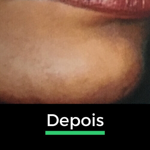 Comparação do queixo depois da depilação a laser, mostrando a eliminação dos pelos indesejados para uma pele mais uniforme.