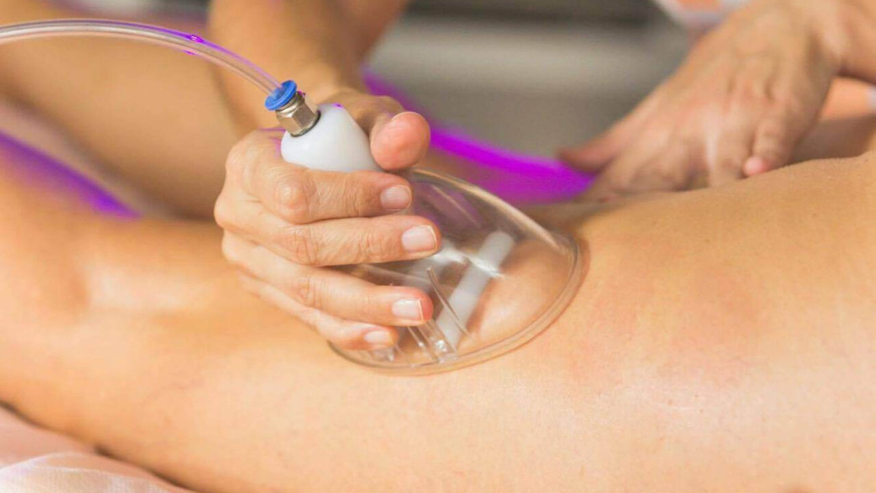 Tratamento de vacuoterapia sendo aplicado nas pernas, utilizando sucção para estimular a circulação e melhorar a aparência da pele.